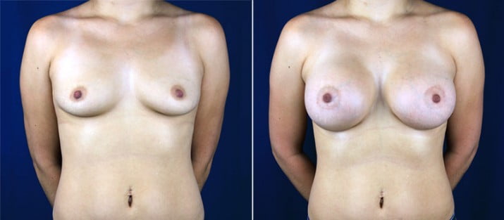 Breast Augmentation 26
