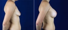 breast-augmentation-3115c