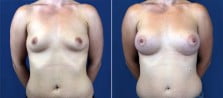 breast-augmentation-3126a