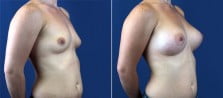 breast-augmentation-3126b
