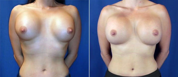 Breast Revision 3
