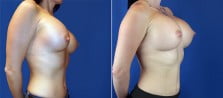 breast-augmentation-revision-3277b