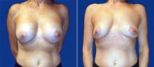 breast-implant-removal-3267a