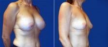 breast-implant-removal-3267b