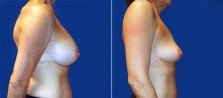 breast-implant-removal-3267c