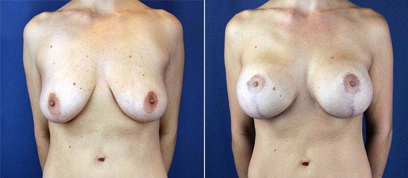 Breast Lift with Implants 2