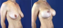 breast-lift-with-implants-3172b