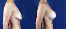 breast-lift-with-implants-3172c