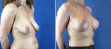 breast-lift-with-implants-3211b
