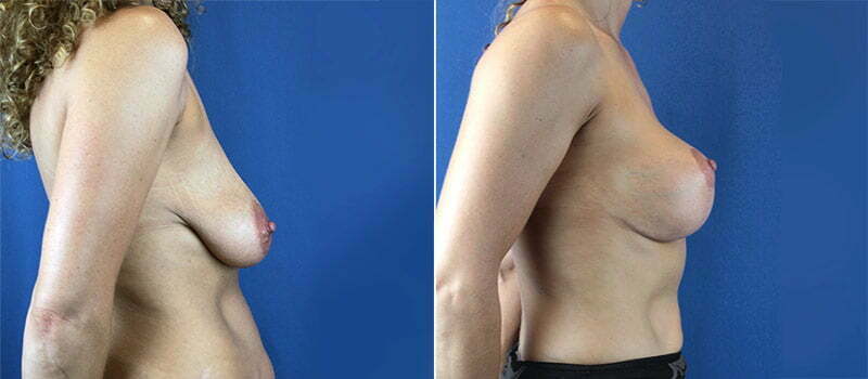 Breast Lift with Implants 4