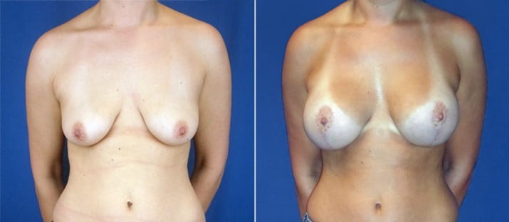 Breast Lift with Implants 5