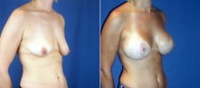 breast-lift-with-implants-3223b