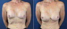 Breast Revision 4