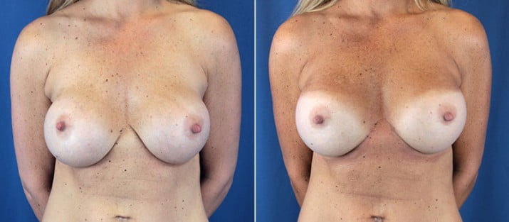 Breast Revision 5