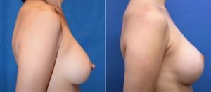nipple-reduction-02