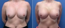 breast-implant-revision-105a-buford