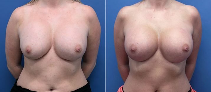 Breast Revision 11