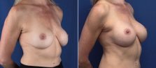 breast-implant-revision-2386b-buford