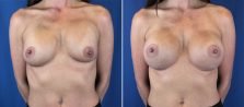 breast-implant-revision-2580a-buford