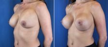 breast-implant-revision-2580b-buford