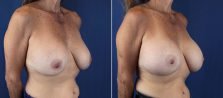breast-implant-revision-with-lift-2134b-buford