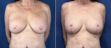 Breast Revision 6