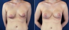 Breast Lift with Implants 10