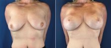 Breast Lift with Implants 8