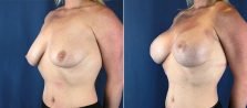 breast-lift-with-augmentation-1875b-buford