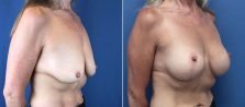 breast-lift-with-augmentation-2614b-buford