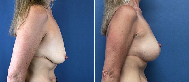 Breast Lift with Implants 7