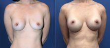 breast-lift-with-augmentation-3620-a-buford