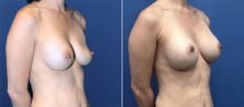 breast-lift-with-augmentation-3620-b-buford