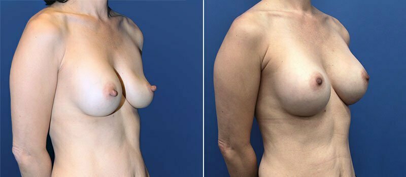 Breast Augmentation with Nipple Reduction 6