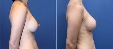 breast-lift-with-augmentation-3620-c-buford