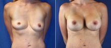 Breast Lift with Implants 9