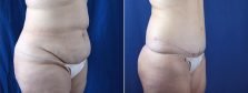 tummy-tuck-with-liposuction-3644b-buford