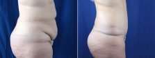 tummy-tuck-with-liposuction-3644c-buford