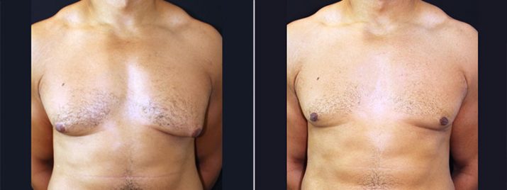 Male Breast Reduction 3