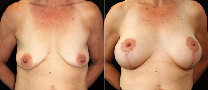 Breast Lift with Implants 11