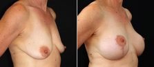breast-lift-with-implants-17990b-buford