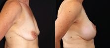 breast-lift-with-implants-17990c-buford