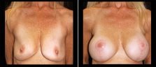 breast-lift-with-implants-17996-a-buford