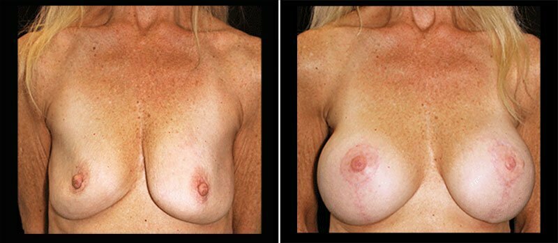Breast Lift with Implants 12