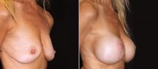 breast-lift-with-implants-17996b-buford