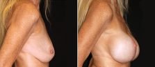 breast-lift-with-implants-17996c-buford