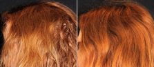 hair-restoration-prp-01c-buford