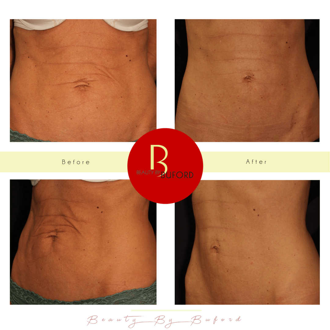 Before and After Photos of Tummy Tightening with Renuvion and Liposuction  instead of Tummy Tuck