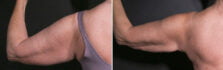 arms-liposuction-renuvion-100d-left-buford