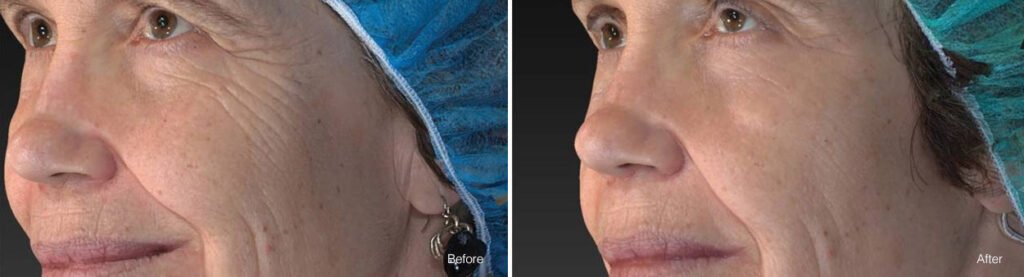 before and after of a face with fewer wrinkles and smoother skin in "after" photo